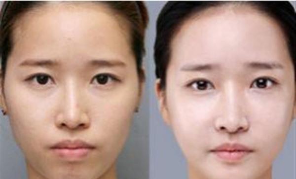 E光<a href=http://www.mx185.com/listinfo-770-0.html target=_blank class=infotextkey>嫩肤</a>手术的方法是什么?