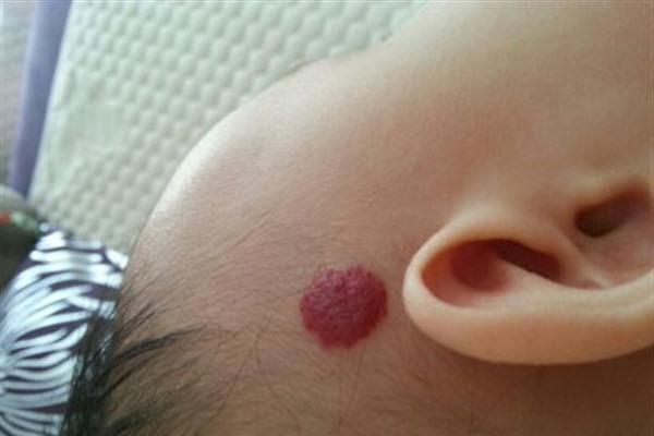 激光<a href=http://www.mx185.com/listinfo-777-0.html target=_blank class=infotextkey>治疗血管瘤</a>麻醉方式是什么？