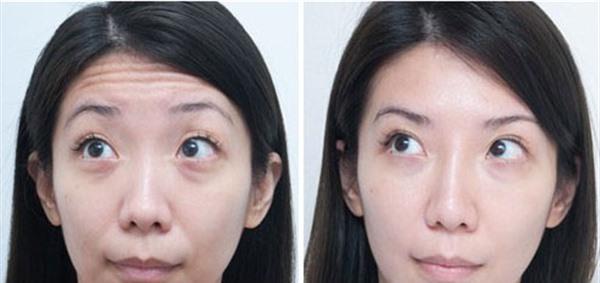 光子除抬头纹麻醉方式是什么？