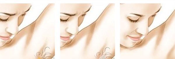 <a href=http://www.mx185.com/listinfo-766-0.html target=_blank class=infotextkey>去腋臭</a>麻醉方式是什么?