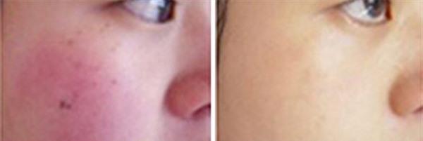 做光子祛红血丝风险有哪些