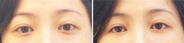 做<a href=http://www.mx185.com/listinfo-782-0.html target=_blank class=infotextkey>去眼角细纹</a>失败修复风险有哪些