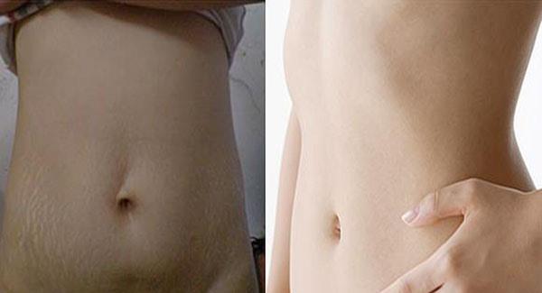 做腹壁整形<a href=http://www.mx185.com/listinfo-791-0.html target=_blank class=infotextkey>去妊娠纹</a>副作用