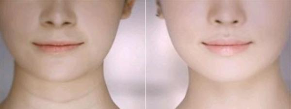 做<a href=http://www.mx185.com/listinfo-731-0.html target=_blank class=infotextkey>玻尿酸</a>除颈纹费用大概需要多少