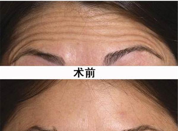 做<a href=http://www.mx185.com/listinfo-734-0.html target=_blank class=infotextkey>爱贝芙</a>去除抬头纹价格