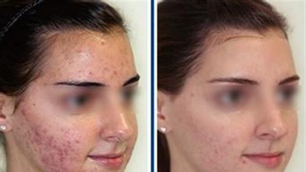 做光子祛痘价格是多少