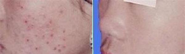 切除缝合治疗痘疤手术安全吗?