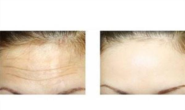 光子除抬头纹需要怎么护理？