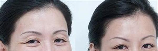 微晶磨皮<a href=http://www.mx185.com/listinfo-780-0.html target=_blank class=infotextkey>去鱼尾纹</a>手术注意事项是什么？