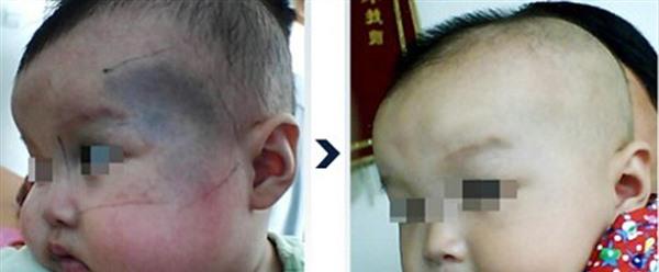 冷冻去除太田痣手术术后护理?