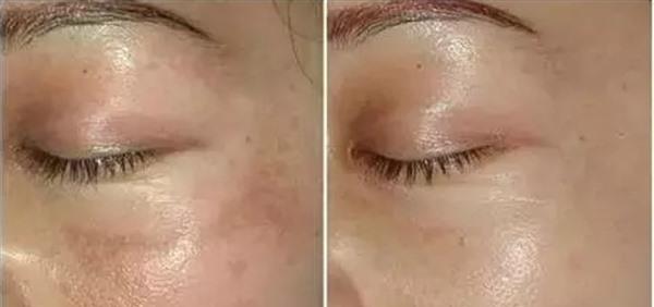 激光去除黄褐斑的方法真的有效吗