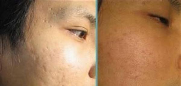 激光去痘印价格多少