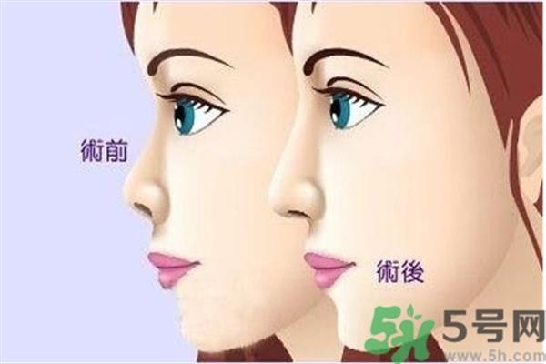 <a href=http://www.mx185.com/listinfo-731-0.html target=_blank class=infotextkey>玻尿酸</a><a href=http://www.mx185.com/listinfo-737-0.html target=_blank class=infotextkey>隆鼻</a>的缺点是什么？<a href=http://www.mx185.com/listinfo-731-0.html target=_blank class=infotextkey>玻尿酸</a><a href=http://www.mx185.com/listinfo-737-0.html target=_blank class=infotextkey>隆鼻</a>的优点有哪些？