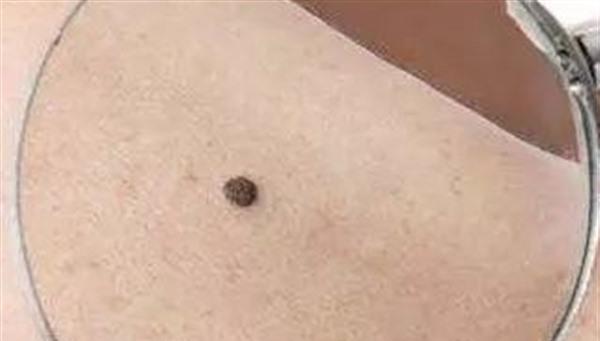 冷冻去痣做完要多久时间？
