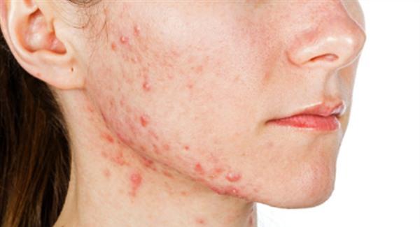 祛痘手术时间需要多久?