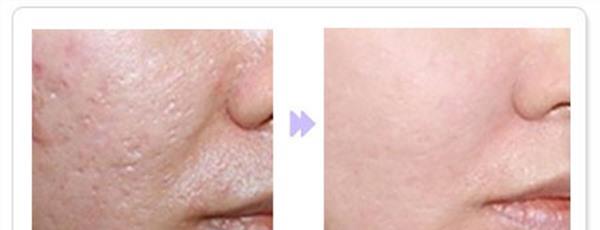 光子去痘印不适用人群有哪些？