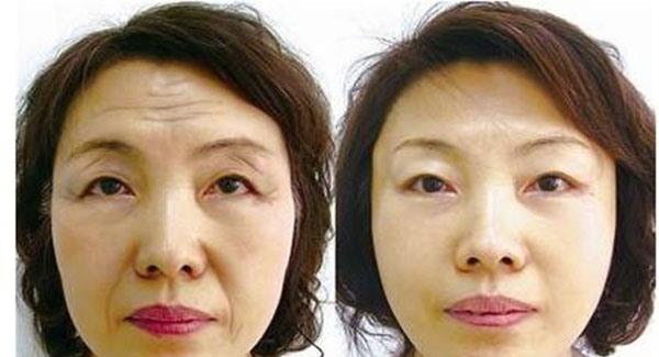 做光子除抬头纹副作用