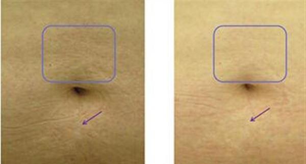 <a href=http://www.mx185.com/listinfo-613-0.html target=_blank class=infotextkey>射频</a><a href=http://www.mx185.com/listinfo-791-0.html target=_blank class=infotextkey>去妊娠纹</a>手术的方法是什么?