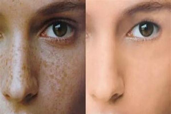 <a href=http://www.mx185.com/listinfo-774-0.html target=_blank class=infotextkey>去雀斑</a>麻醉方式是什么?