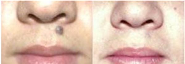 点痣麻醉方式是什么？