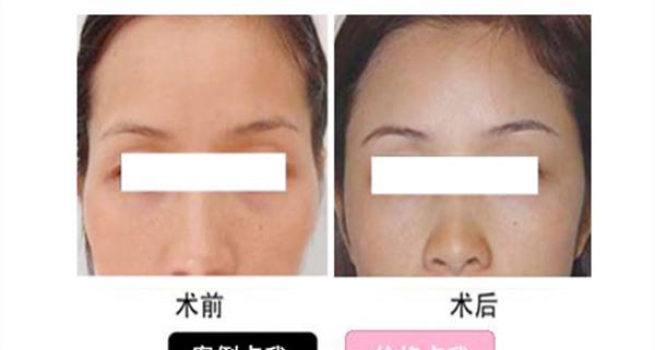 自体脂肪<a href=http://www.mx185.com/listinfo-797-0.html target=_blank class=infotextkey>去痘疤</a>麻醉方式是什么？