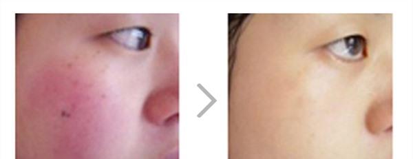 做光子祛红血丝效果好不好