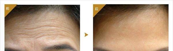 做<a href=http://www.mx185.com/listinfo-764-0.html target=_blank class=infotextkey>面部年轻化</a>副作用是什么