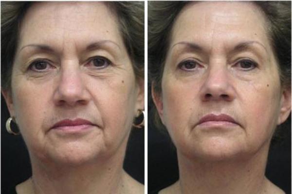 E光<a href=http://www.mx185.com/listinfo-792-0.html target=_blank class=infotextkey>去法令纹</a>手术缺点有哪些？