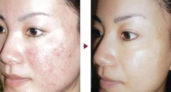 做激光祛痘价格贵吗