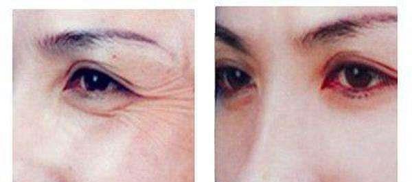 做激光<a href=http://www.mx185.com/listinfo-782-0.html target=_blank class=infotextkey>去眼角细纹</a>价格要多少