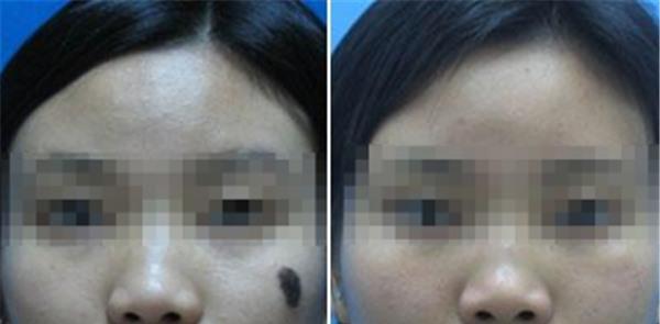 做<a href=http://www.mx185.com/listinfo-788-0.html target=_blank class=infotextkey>去黑痣</a>价格多少钱