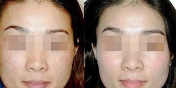 做激光<a href=http://www.mx185.com/listinfo-795-0.html target=_blank class=infotextkey>祛斑</a>价格多少钱