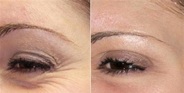 做自体脂肪<a href=http://www.mx185.com/listinfo-780-0.html target=_blank class=infotextkey>去鱼尾纹</a>费用大概需要多少