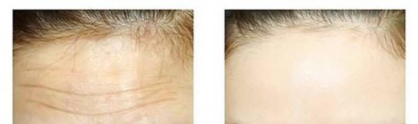 做额颞部<a href=http://www.mx185.com/listinfo-614-0.html target=_blank class=infotextkey>除皱</a><a href=http://www.mx185.com/listinfo-765-0.html target=_blank class=infotextkey>去抬头纹</a>价格