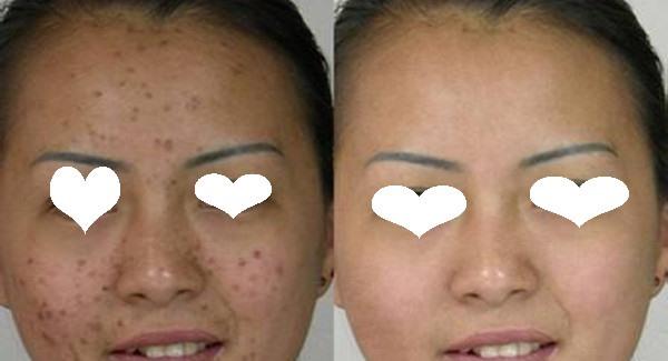 做E光去痘印价格是多少