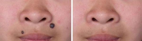 做光子点痣费用大概需要多少