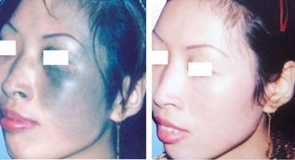 做光子治疗太田痣价格是多少