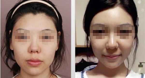 自体脂肪<a href=http://www.mx185.com/listinfo-782-0.html target=_blank class=infotextkey>去眼角细纹</a>手术术后护理?