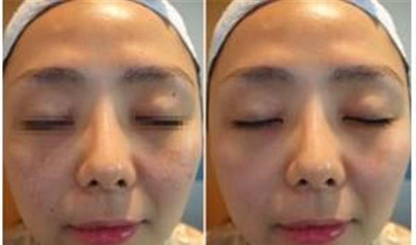 微晶磨皮<a href=http://www.mx185.com/listinfo-780-0.html target=_blank class=infotextkey>去鱼尾纹</a>手术术后护理?