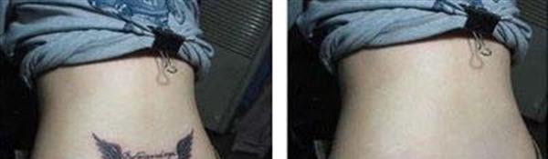 皮肤磨削去纹身手术安全吗？