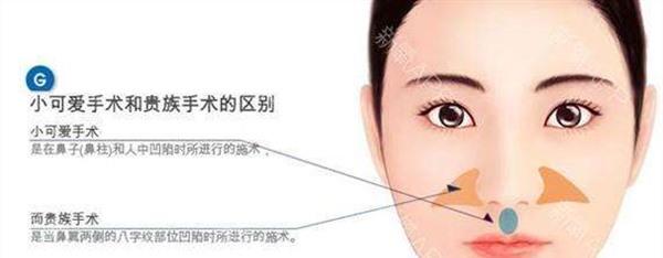 自体脂肪<a href=http://www.mx185.com/listinfo-792-0.html target=_blank class=infotextkey>去法令纹</a>手术安全吗？