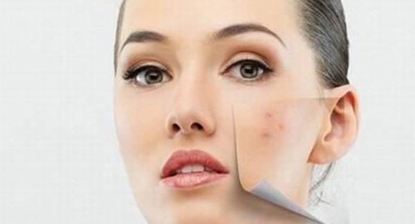 做激光祛痘手术注意事项是什么？