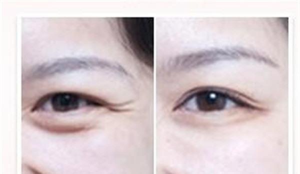 自体脂肪<a href=http://www.mx185.com/listinfo-780-0.html target=_blank class=infotextkey>去鱼尾纹</a>要多少钱？