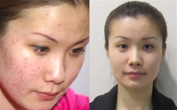 做E光去痘印多少钱