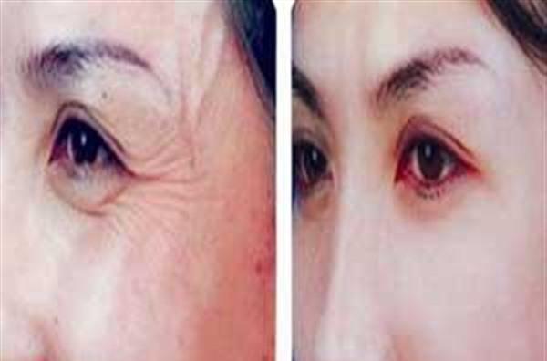 小切口<a href=http://www.mx185.com/listinfo-614-0.html target=_blank class=infotextkey>除皱</a><a href=http://www.mx185.com/listinfo-780-0.html target=_blank class=infotextkey>去鱼尾纹</a>手术注意事项是什么？