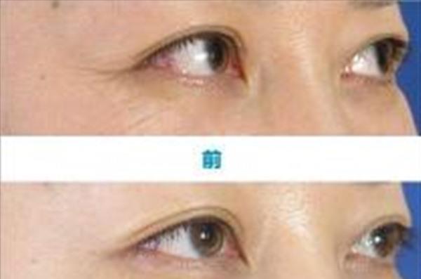 <a href=http://www.mx185.com/listinfo-782-0.html target=_blank class=infotextkey>去眼角细纹</a>手术效果好不好？