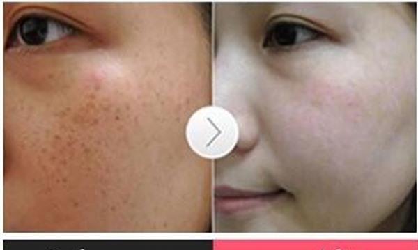 微晶磨削<a href=http://www.mx185.com/listinfo-774-0.html target=_blank class=infotextkey>去雀斑</a>手术效果好不好？