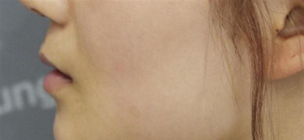 激光<a href=http://www.mx185.com/listinfo-786-0.html target=_blank class=infotextkey>去黄褐斑</a>的护理