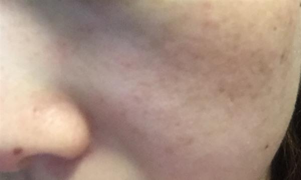 激光<a href=http://www.mx185.com/listinfo-795-0.html target=_blank class=infotextkey>祛斑</a>多久能见效