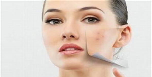 激光祛痘的效果怎么样